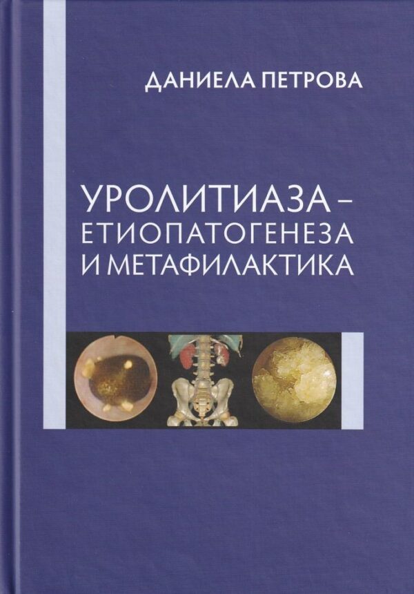 Уролитиаза - Етиопатогенеза и метафилактика